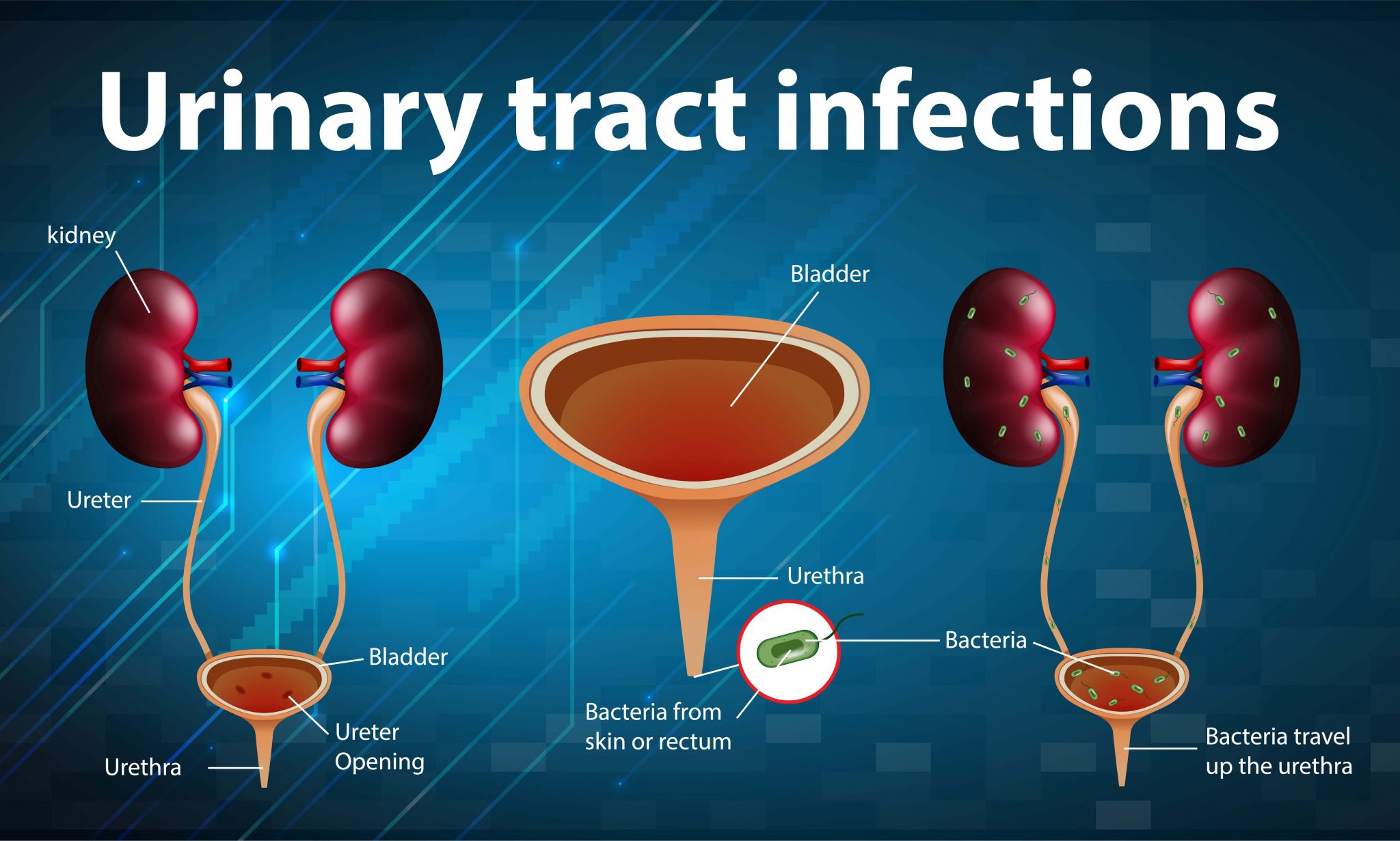 5 Home Remedies For Urinary Tract Infection 2048x1231 