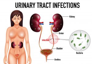 Read more about the article Can I prevent a urinary tract infection (UTI)?