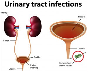 Read more about the article Urinary Tract Infection (UTIs): Symptoms, Causes and Treatment