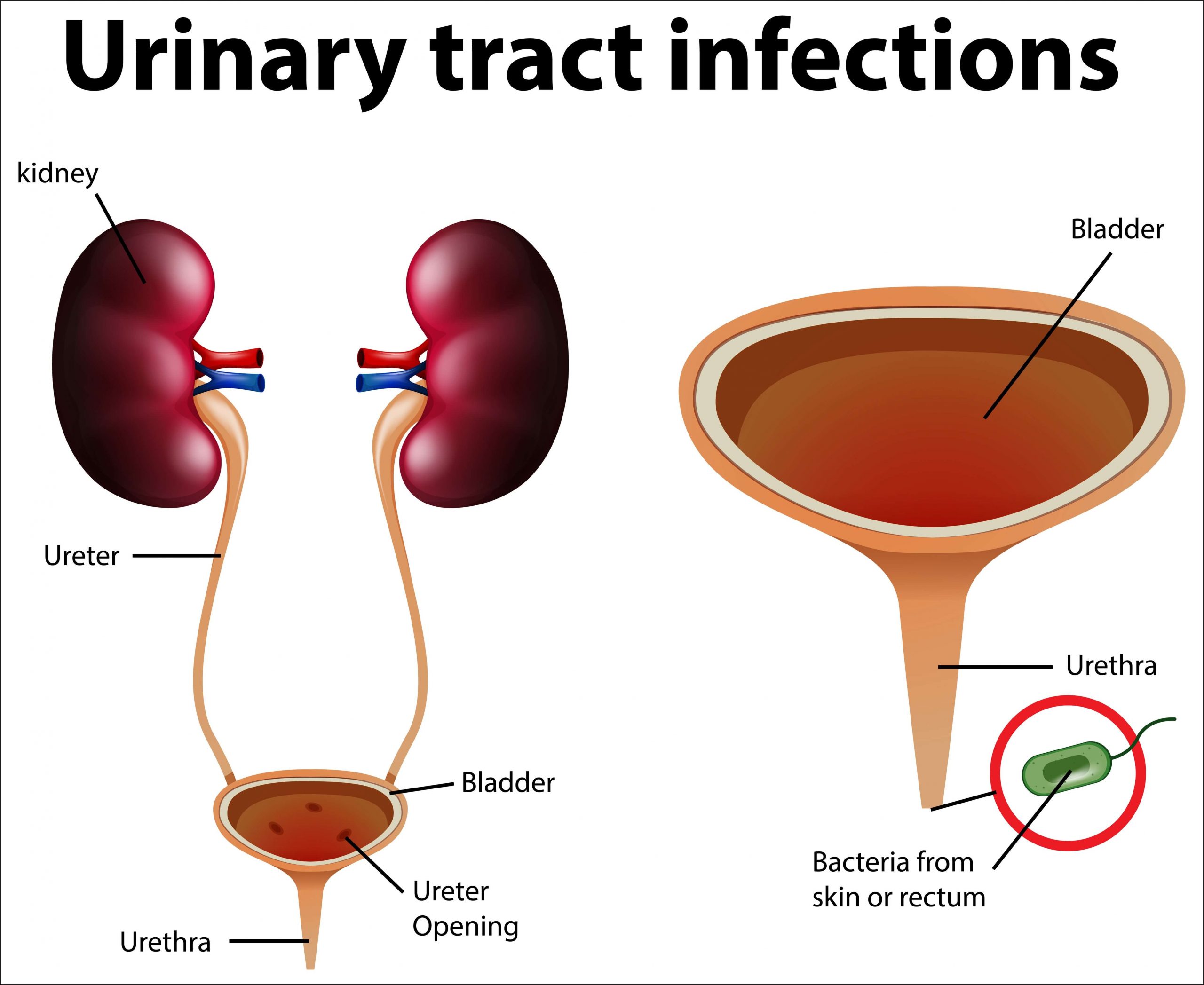 You are currently viewing Urinary Tract Infection (UTIs): Symptoms, Causes and Treatment
