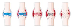Read more about the article <strong>Rheumatoid arthritis symptoms and causes</strong>