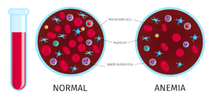 Read more about the article <strong>What is Anemia: Symptoms and Causes</strong>