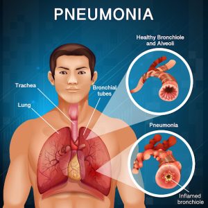 Read more about the article <strong>Pneumonia symptoms and causes</strong>