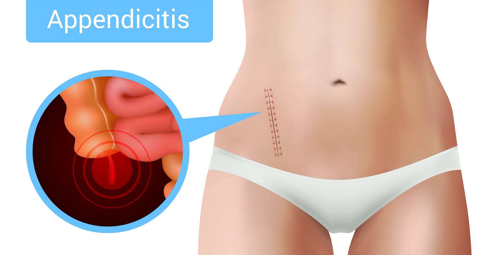 Read more about the article Appendicitis causes and symptoms