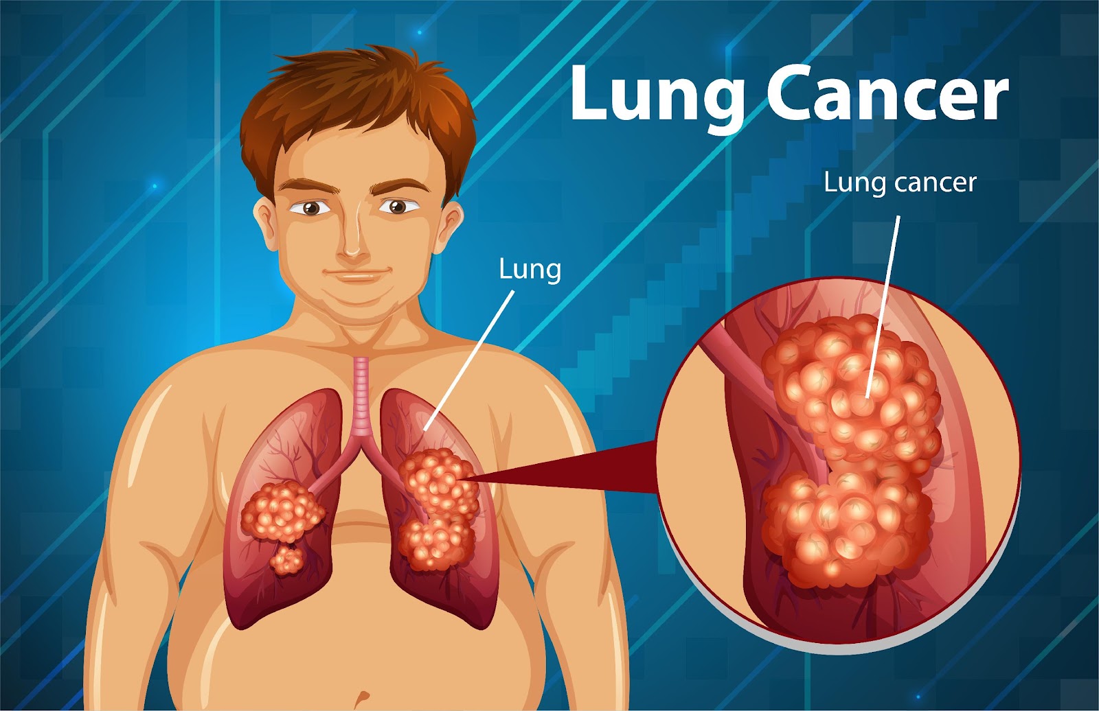 You are currently viewing Symptoms and causes of Lung cancer