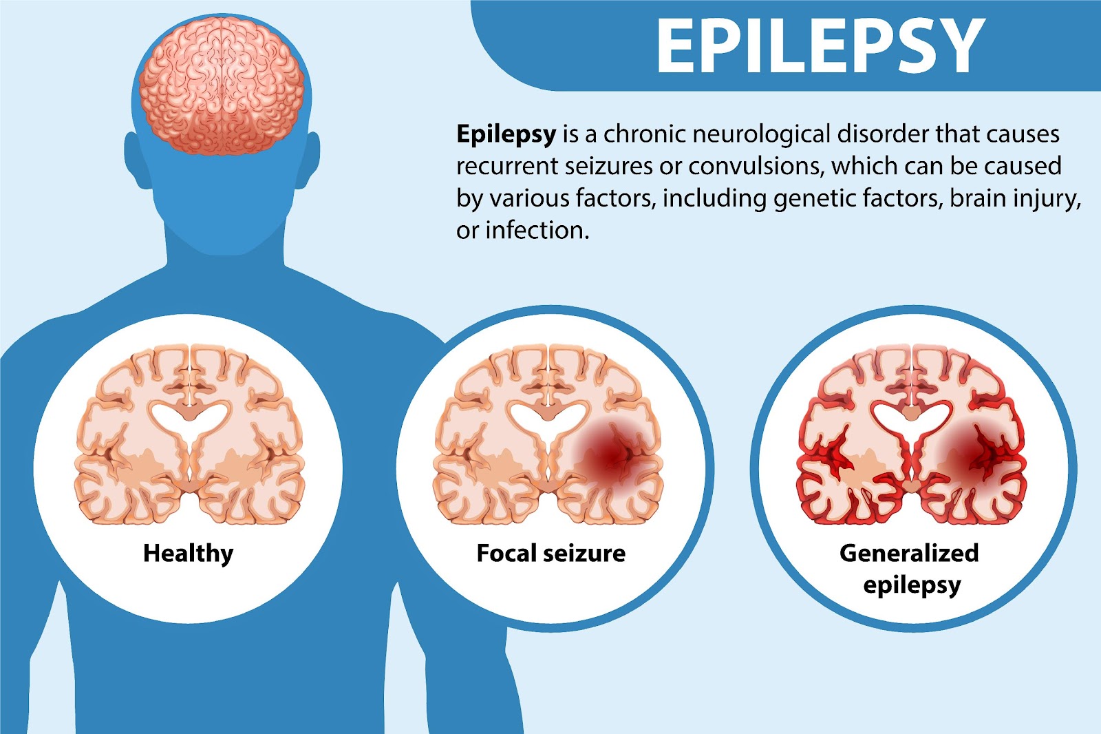 You are currently viewing Epilepsy: Its symptoms and causes