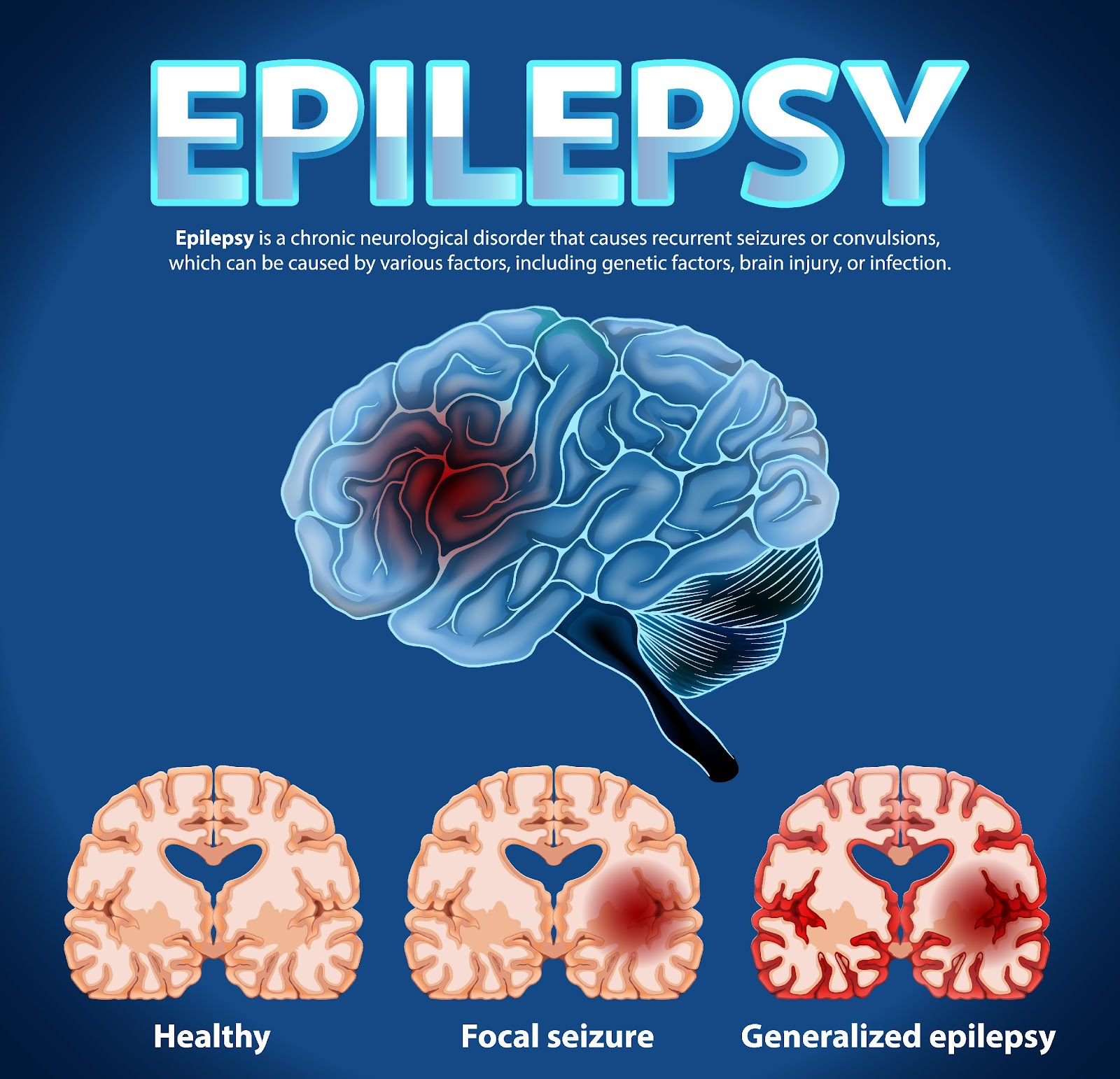 Read more about the article Types of Epilepsy and its triggers