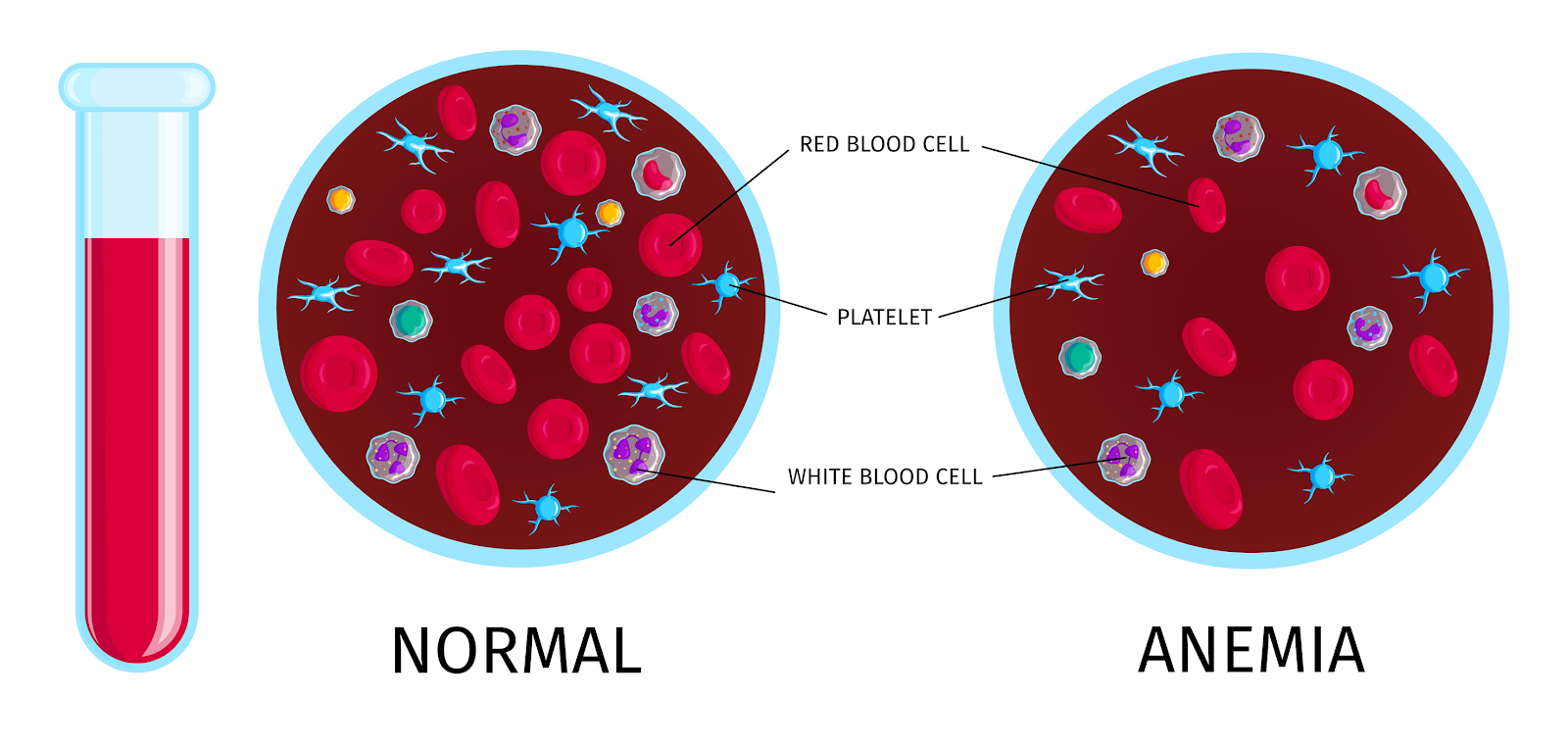 Read more about the article Hemolytic Anemia: Its symptoms and causes